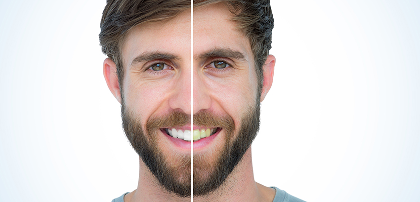 young man with beards face being split in half showing before and after difference that cosmetic dentistry can do