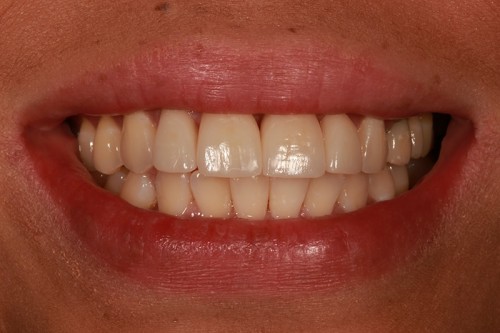 replaced composite fillings on her front teeth with beautiful porcelain veneers and crowns