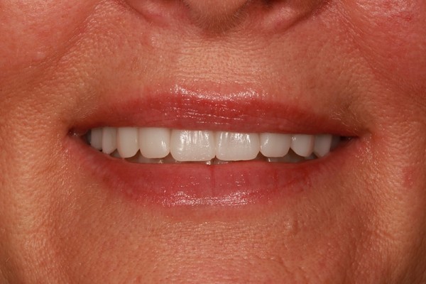 regain youthful look with TMJ treatment