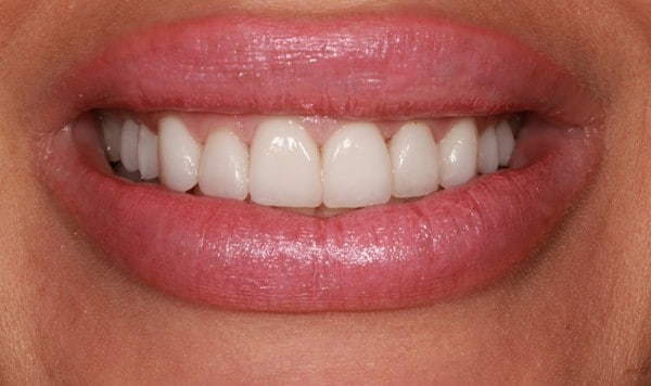 beautiful veneers