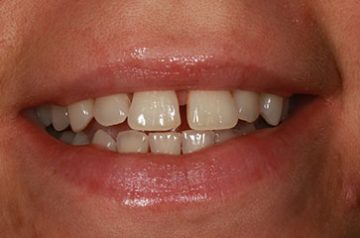 closeup of smile before cosmetic dental procedure