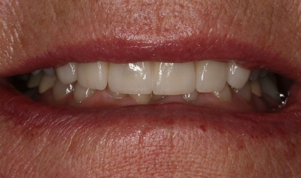 restored smile thanks to Dr. Kendall Skinner