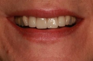 patient after smile makeover
