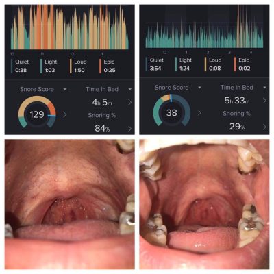 Snoring treatment results