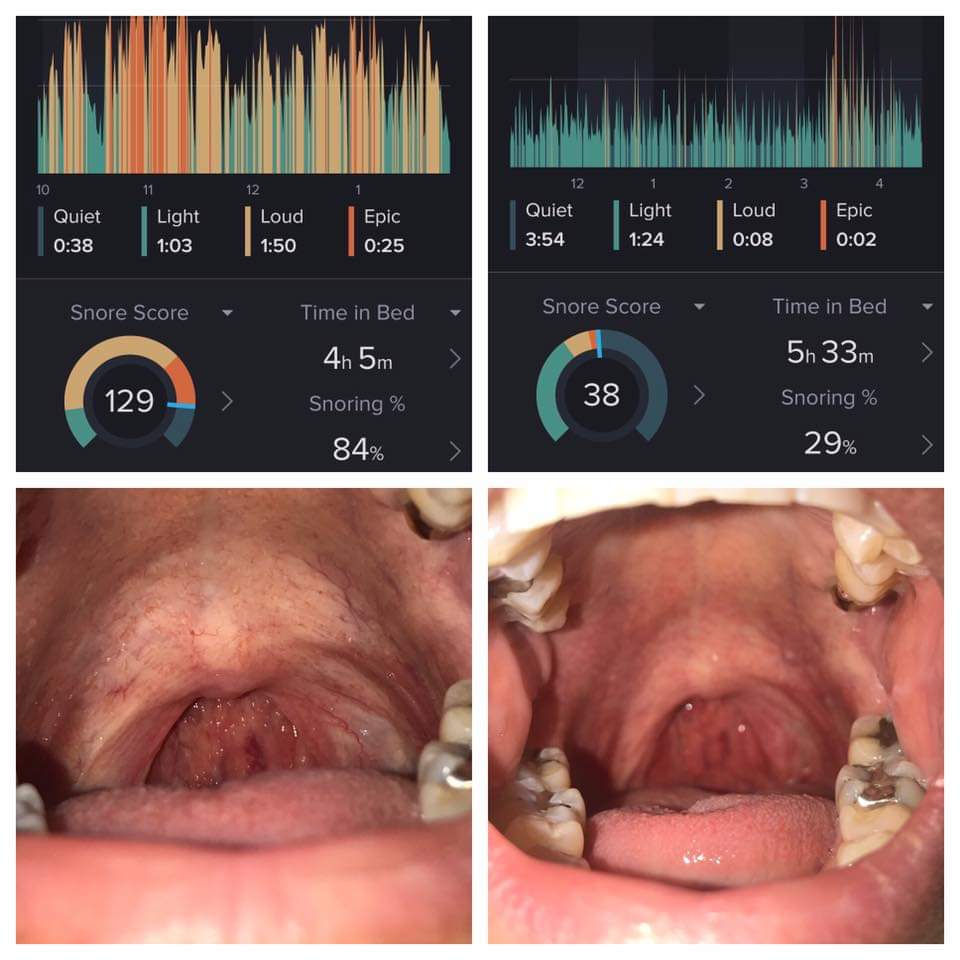 Sleep Apnea & Snoring Treatment in Anchorage, Alaska