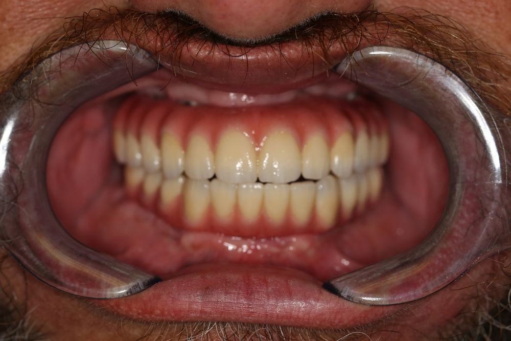Chris’s Story: Rebuilding His Smile and Confidence