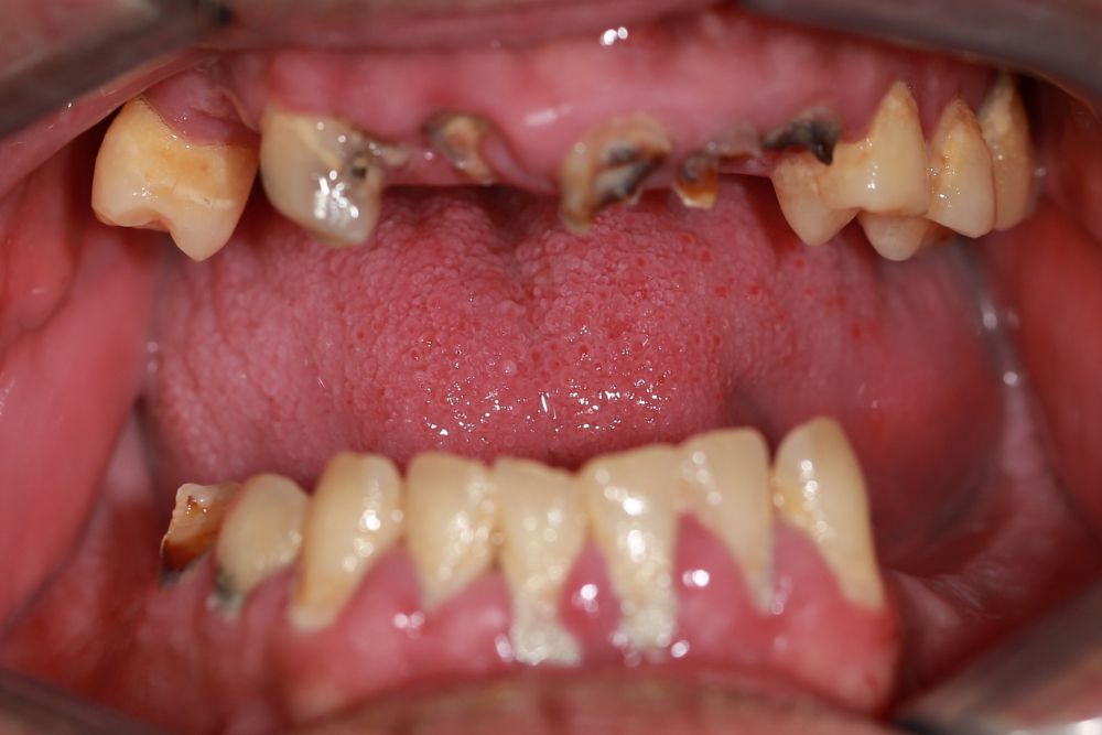 Chris’s Story: Rebuilding His Smile and Confidence