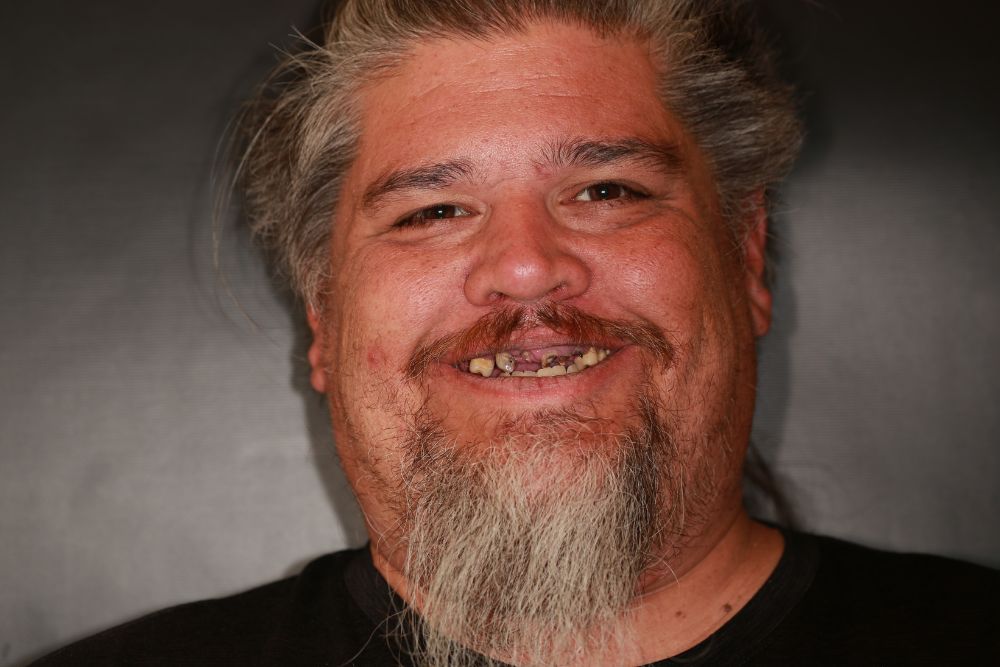 Chris’s Story: Rebuilding His Smile and Confidence